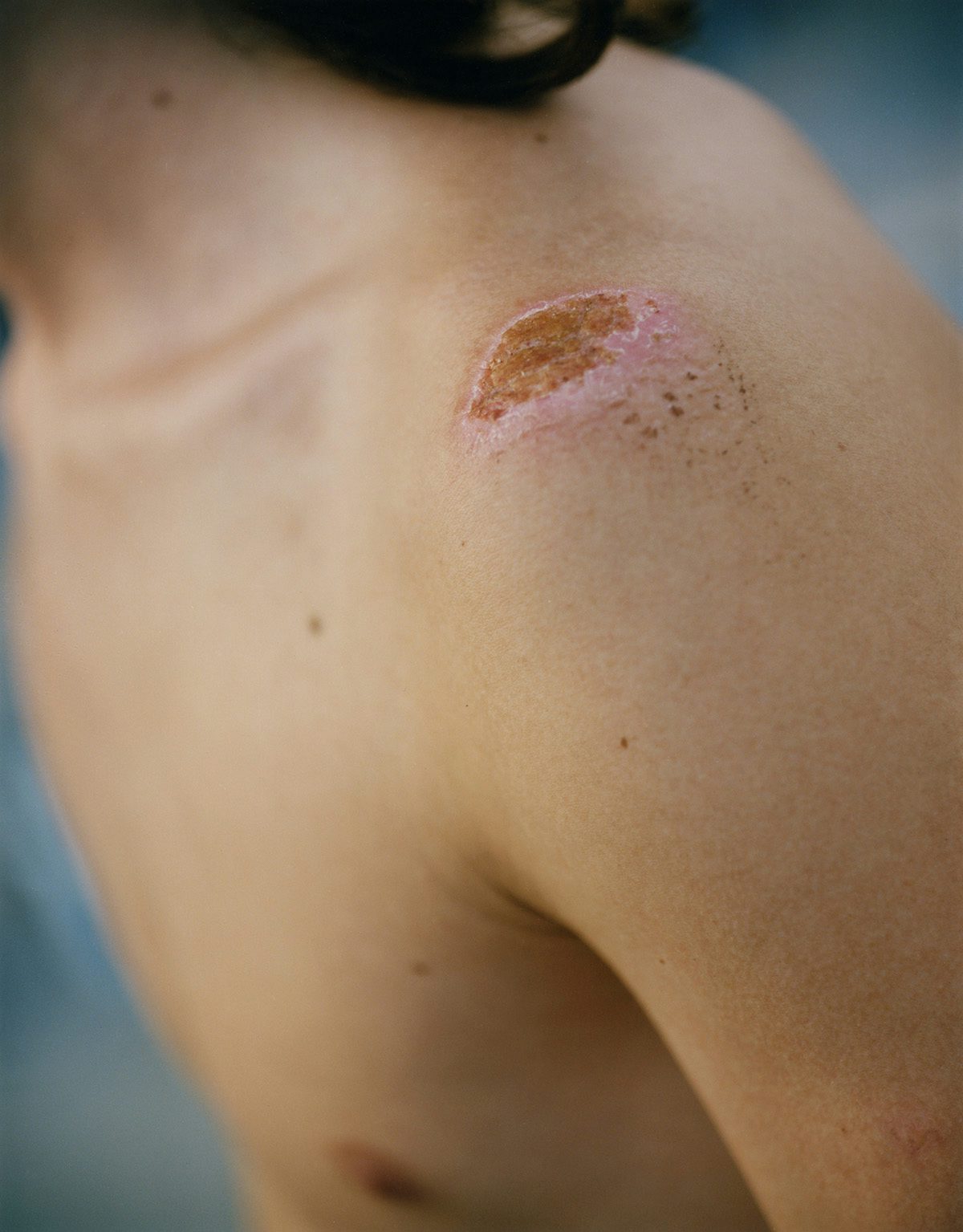 Close-up of a graze on a person's shoulder