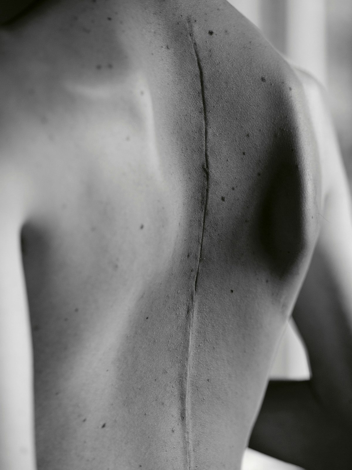 Black and white close-up photo of a boy's back which has a large vertical scar running down it