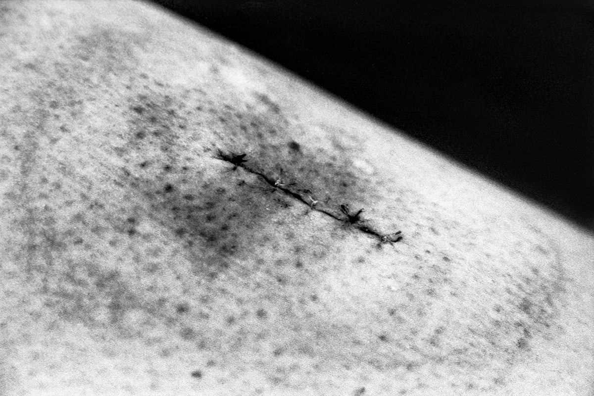 Black and white close up photo of bruised skin with stitches