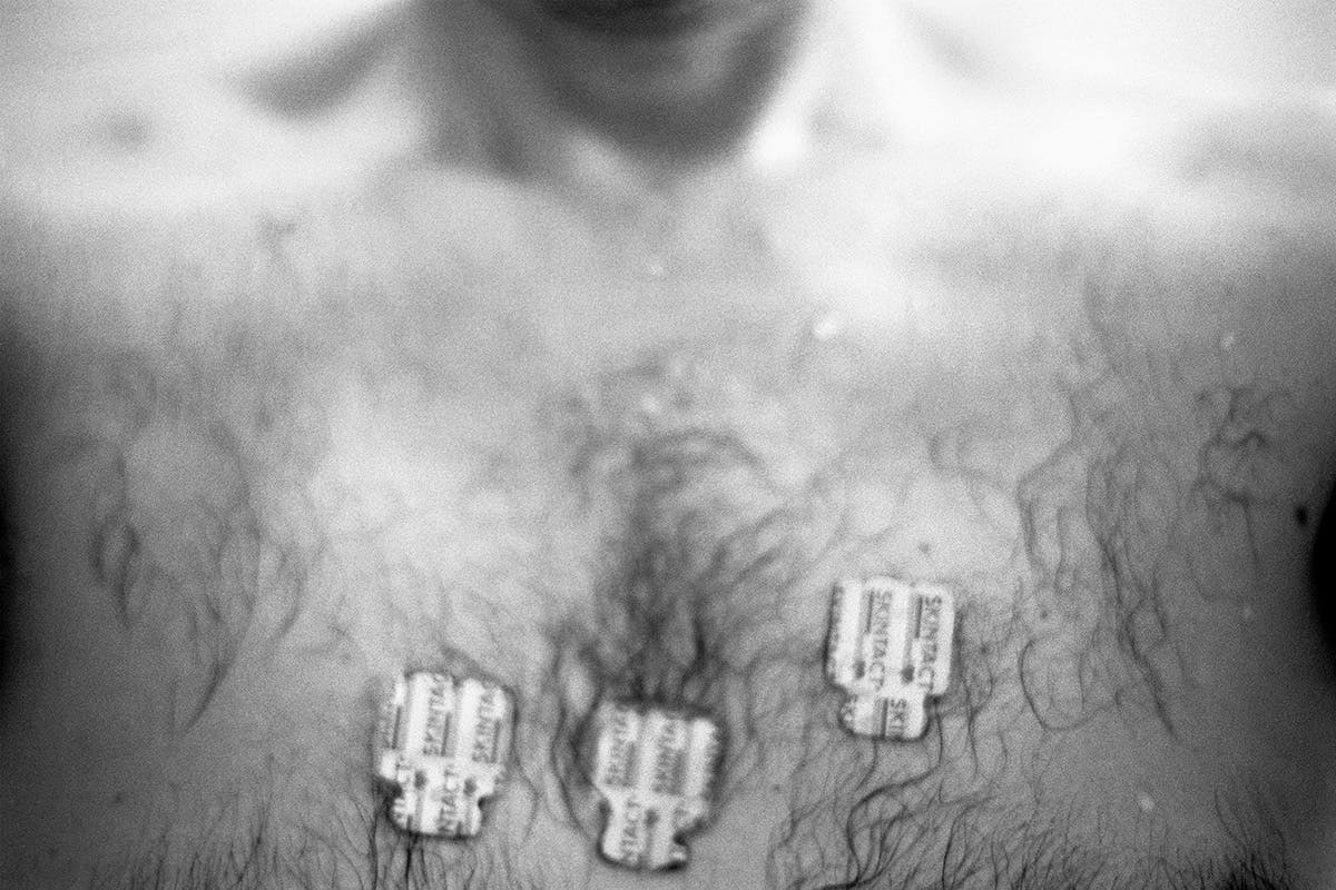Black and white photo of a person's bare chest with ECG tags attached